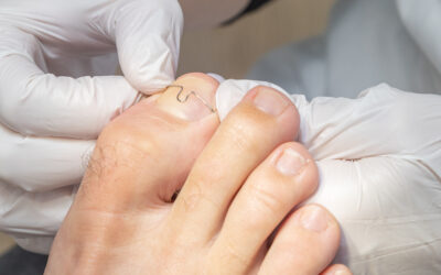 Orthonyxie pour les ongles incarnés au pied